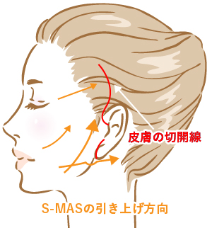 S-MAS処理の工夫