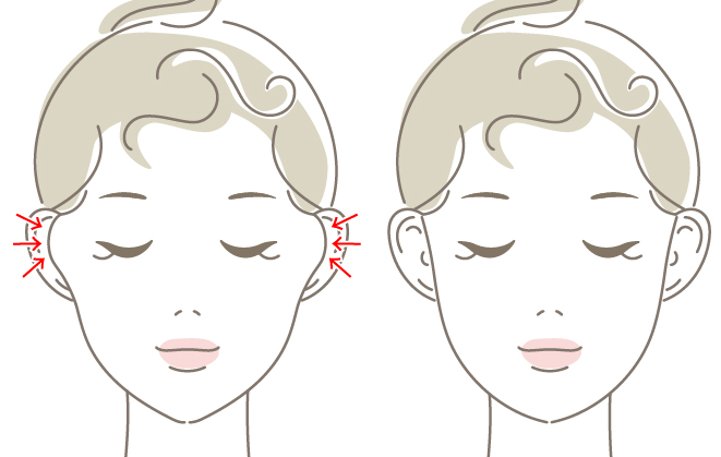 頬骨削り