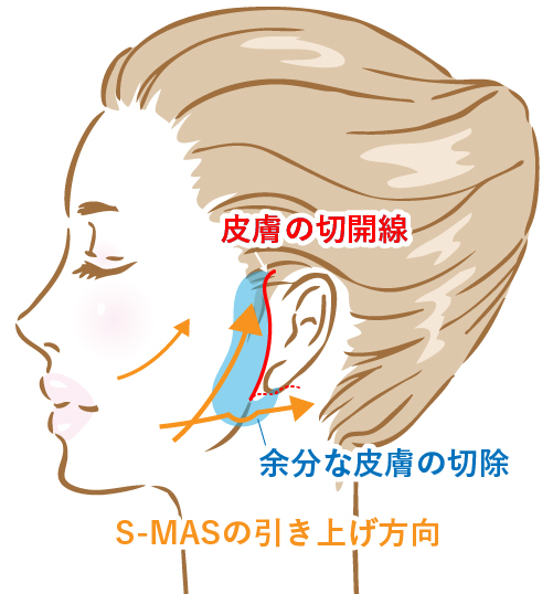 頬リフト（ミニリフト）