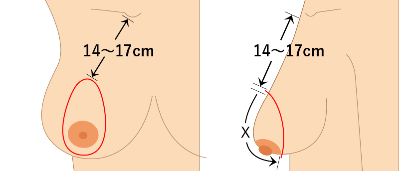 乳房吊り上げ