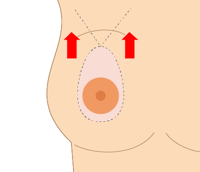 乳房吊り上げ