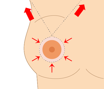 乳房吊り上げ