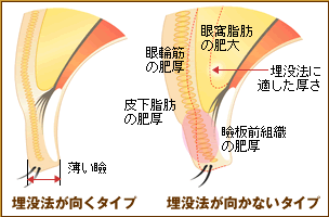 埋没法が向くタイプ、向かないタイプ